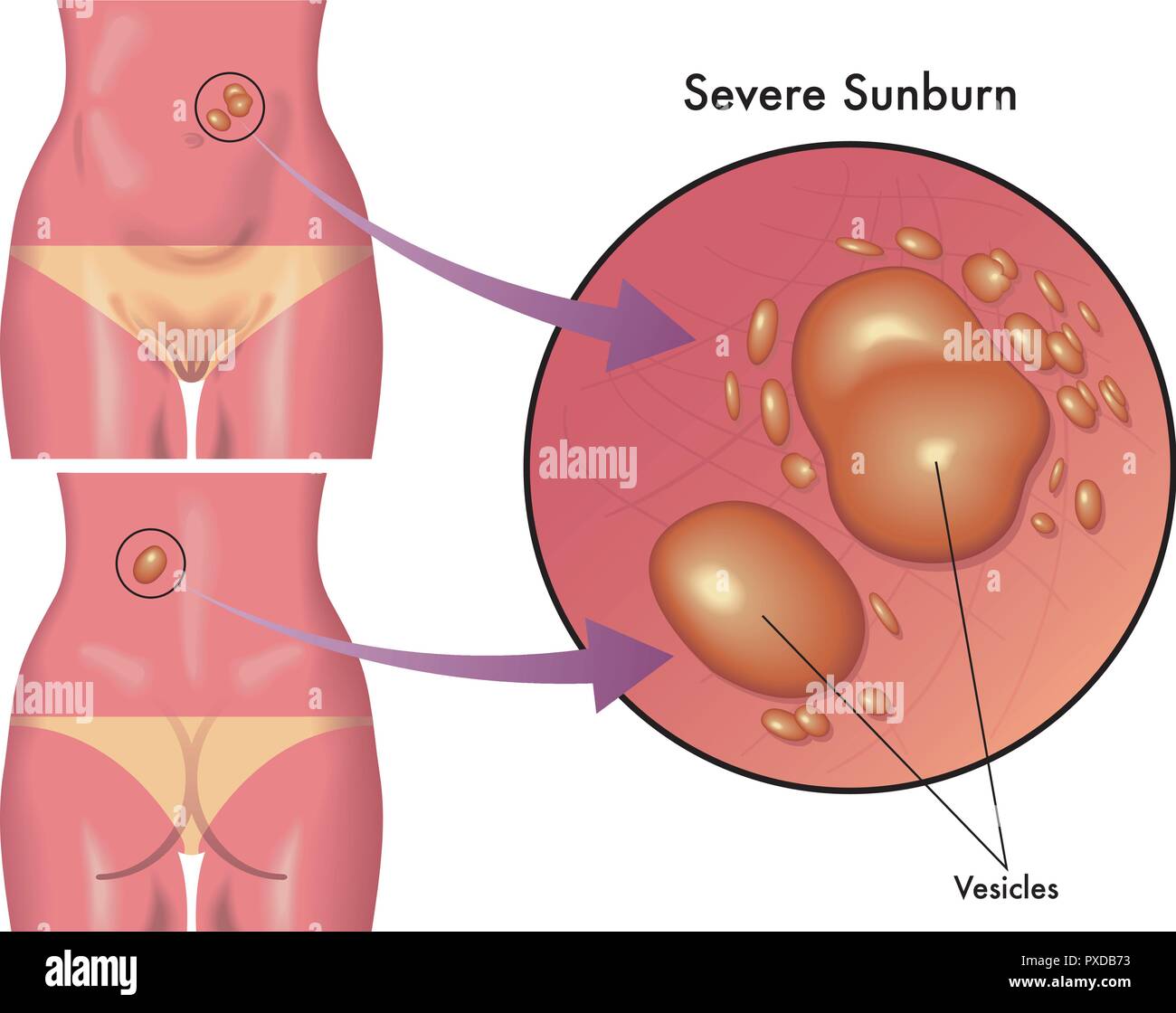 Illustrazione medica delle conseguenze di gravi scottature Illustrazione Vettoriale