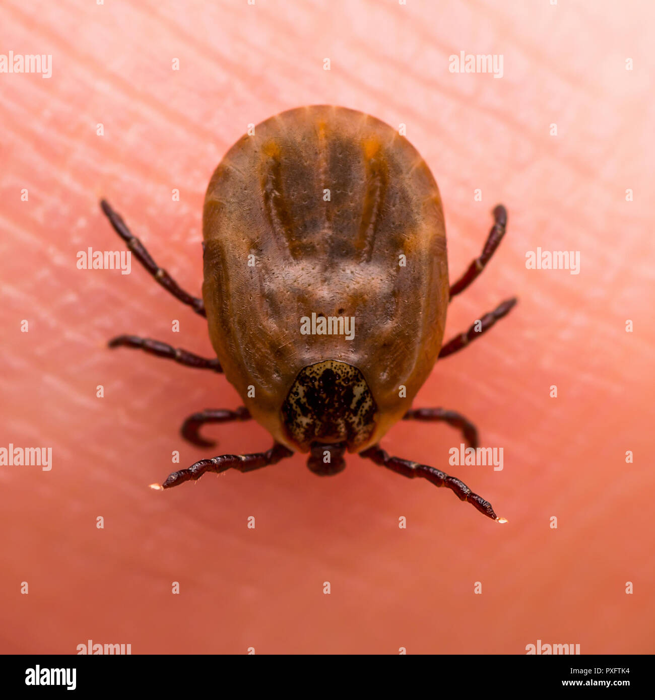 Virus dell'encefalite o borelliosi di Lyme malattia infettiva Tick Dermacentor aracnide insetto sulla pelle Macro Foto Stock