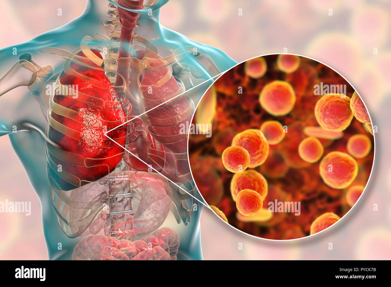 La polmonite causata da Mycoplasma pneumoniae batteri, concettuale illustrazione del computer. I micoplasmi sono i più piccoli organismi cellulari noto (diametro Foto Stock