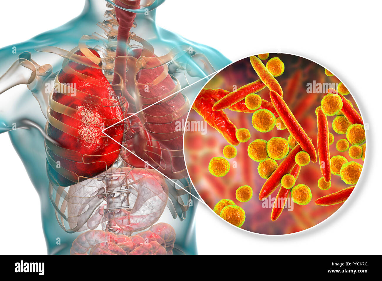 La polmonite causata da Mycoplasma pneumoniae batteri, concettuale illustrazione del computer. I micoplasmi sono i più piccoli organismi cellulari noto (diametro Foto Stock