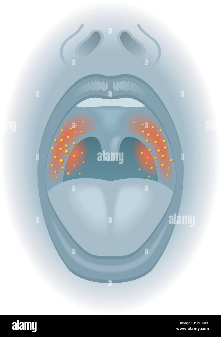 Illustrazione medica di gli effetti del mal di gola Illustrazione Vettoriale