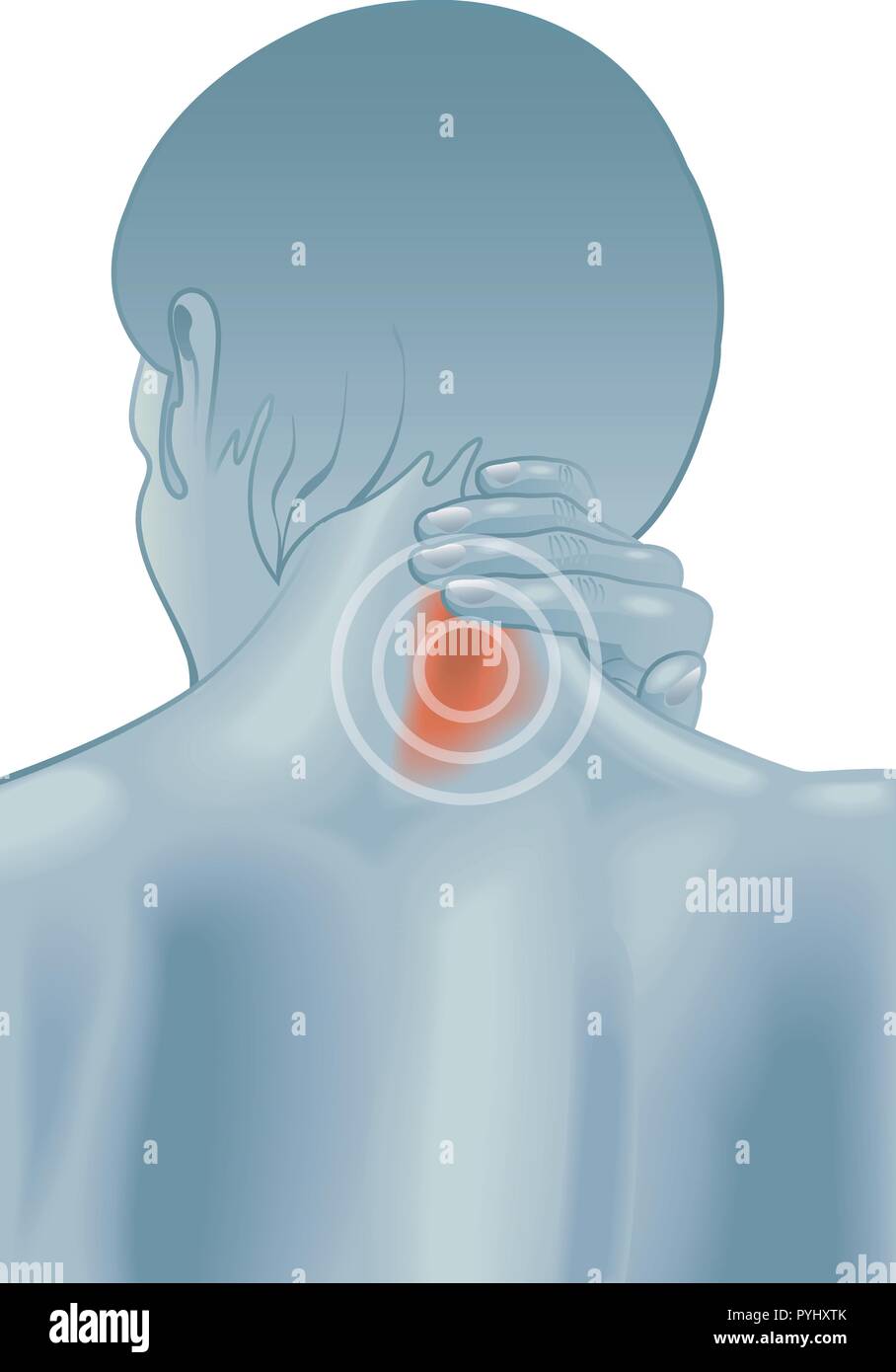 Illustrazione medica di una donna con i sintomi di collo duro Illustrazione Vettoriale
