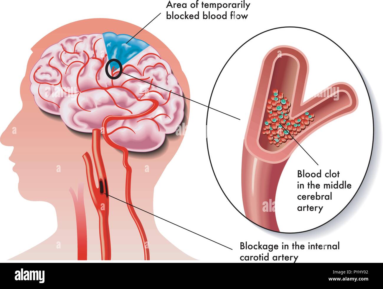 Illustrazione medica degli effetti della TIA (attacco ischemico transitorio) Illustrazione Vettoriale