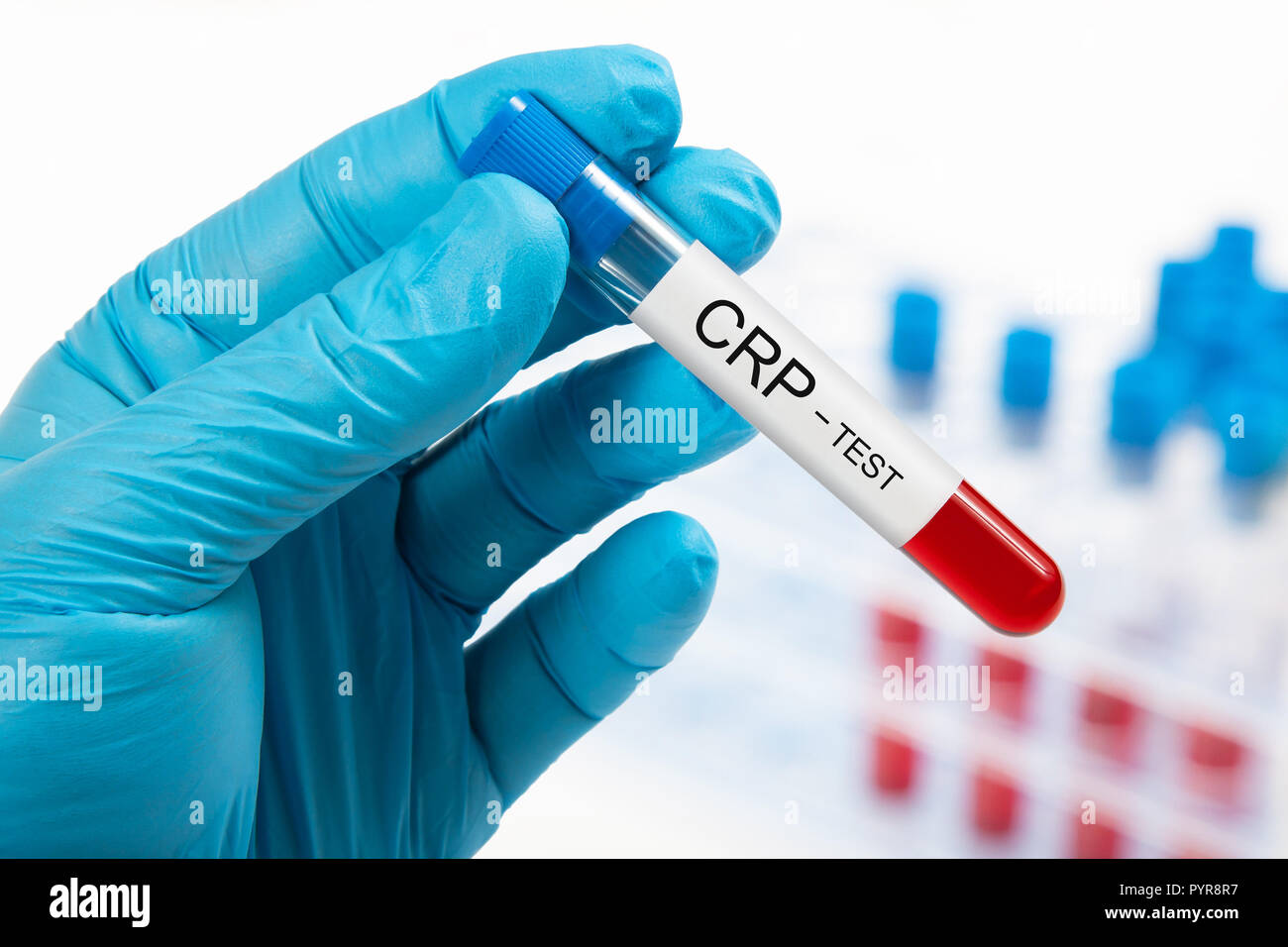 Mano che tiene il campione di sangue per il test CRP Foto Stock