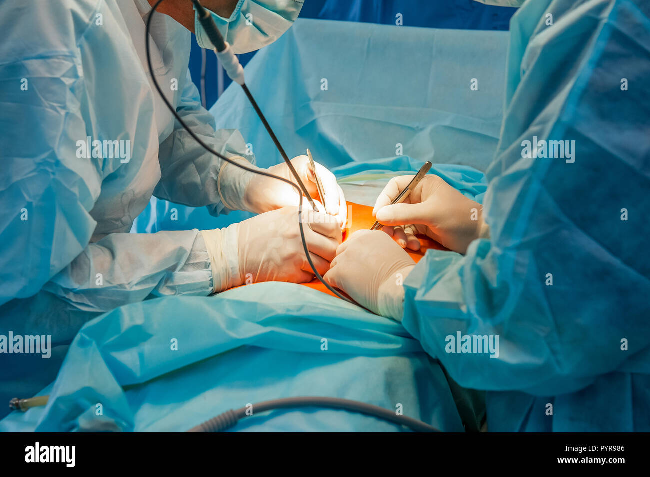 Complessa operazione laparoscopica su una cavità peritoneale viene effettuata in quattro mani Foto Stock