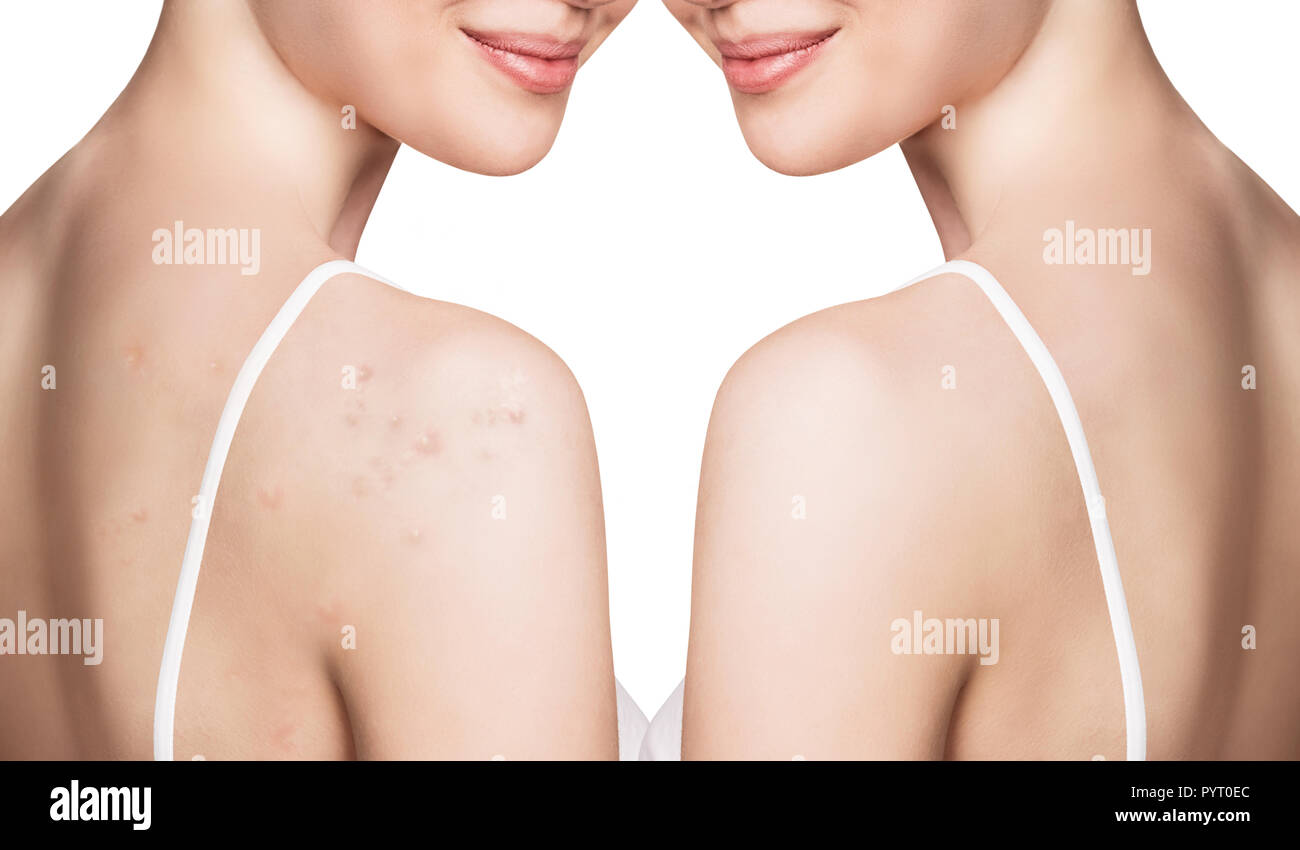 Giovane donna con acne su spalle prima e dopo il trattamento Foto stock -  Alamy
