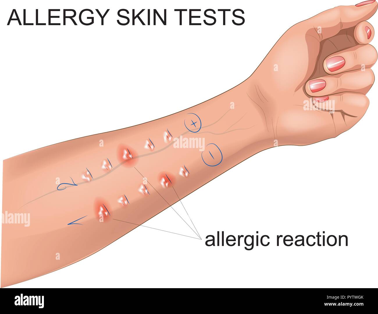 Illustrazione vettoriale di eseguire scratch test per allergie Illustrazione Vettoriale