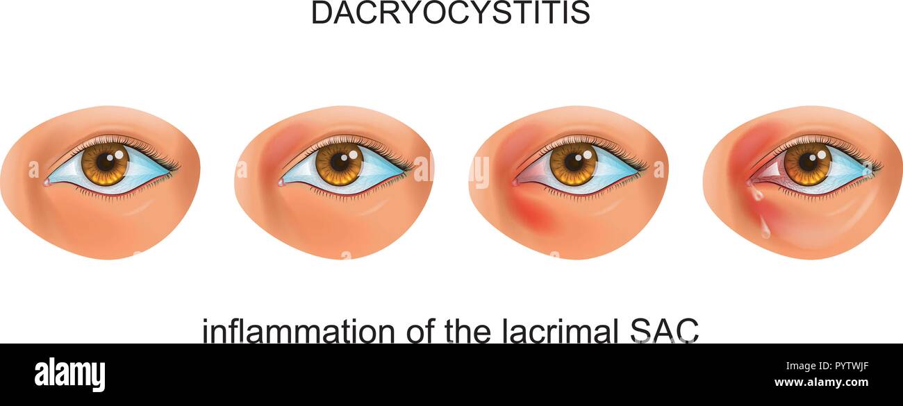 Illustrazione vettoriale di infiammazione dello strappo SAC dell'occhio. dacriocistite Illustrazione Vettoriale