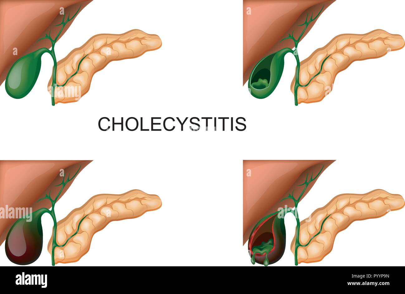 Illustrazione vettoriale di un fegato, cistifellea e pancreas. colecistite Illustrazione Vettoriale