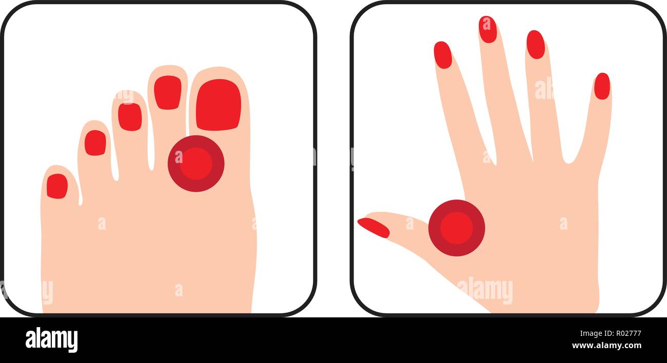 E dolorosa infiammazione per mani e piedi Illustrazione Vettoriale