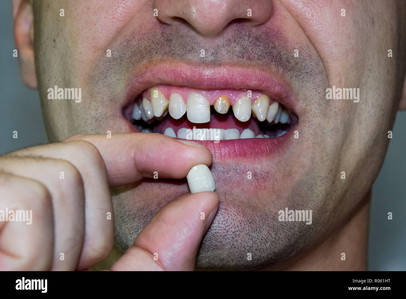 Protesi dentale di metallo di ceramica nella mano di un uomo senza un  dente. Un paziente senza un dente sta cercando su una dentiera. Dente di  impianto dentale Foto stock - Alamy