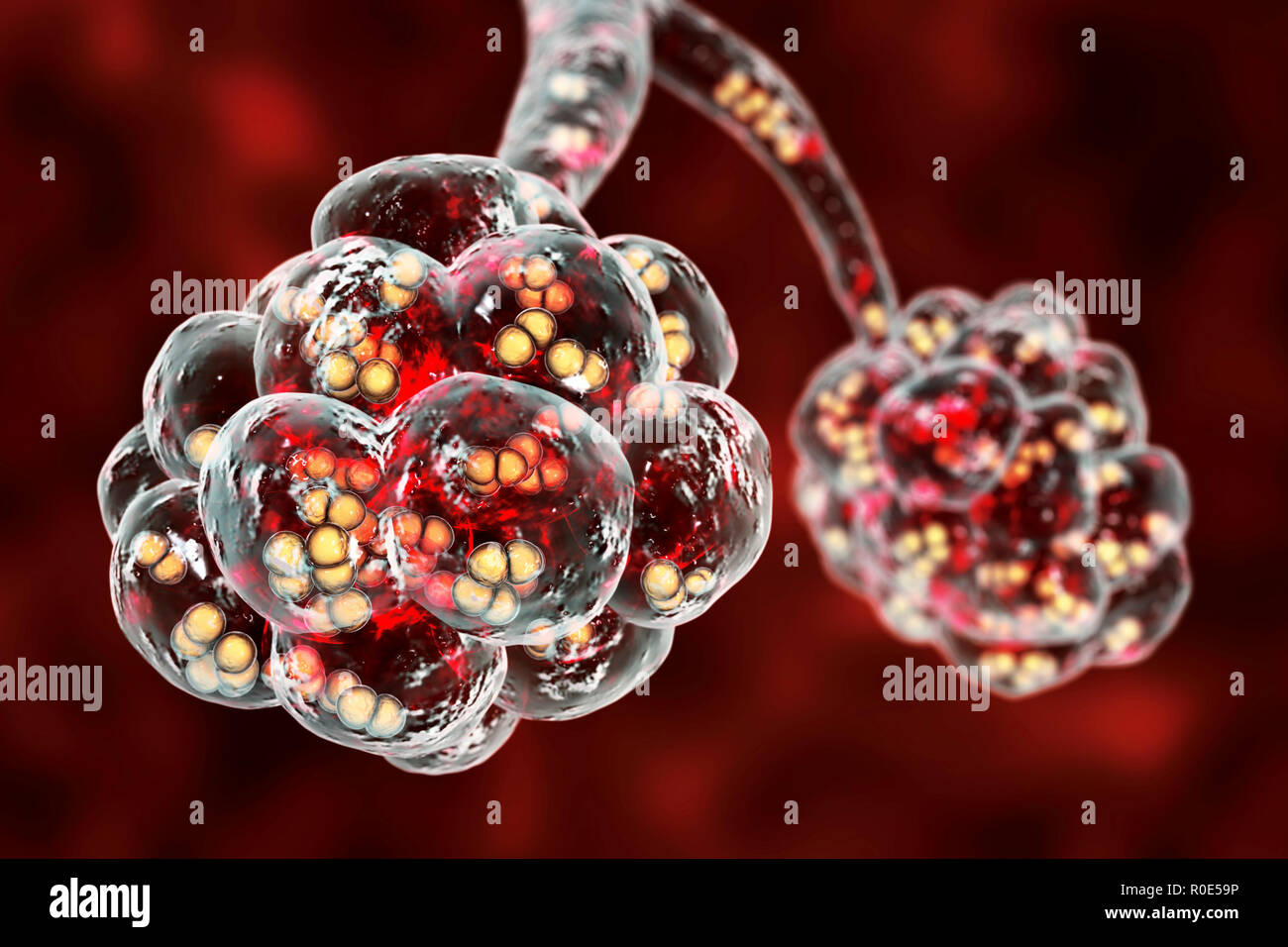Polmonite pneumococcica. Illustrazione del calcolatore di Streptococcus pneumoniae (pneumococchi) batteri negli alveoli dei polmoni, causando la polmonite. Foto Stock