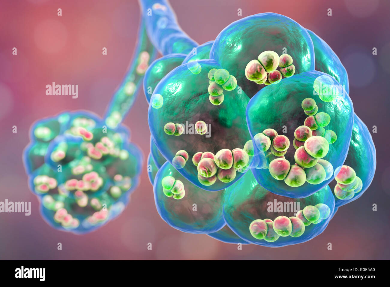 Polmonite pneumococcica. Illustrazione del calcolatore di Streptococcus pneumoniae (pneumococchi) batteri negli alveoli dei polmoni, causando la polmonite. Foto Stock