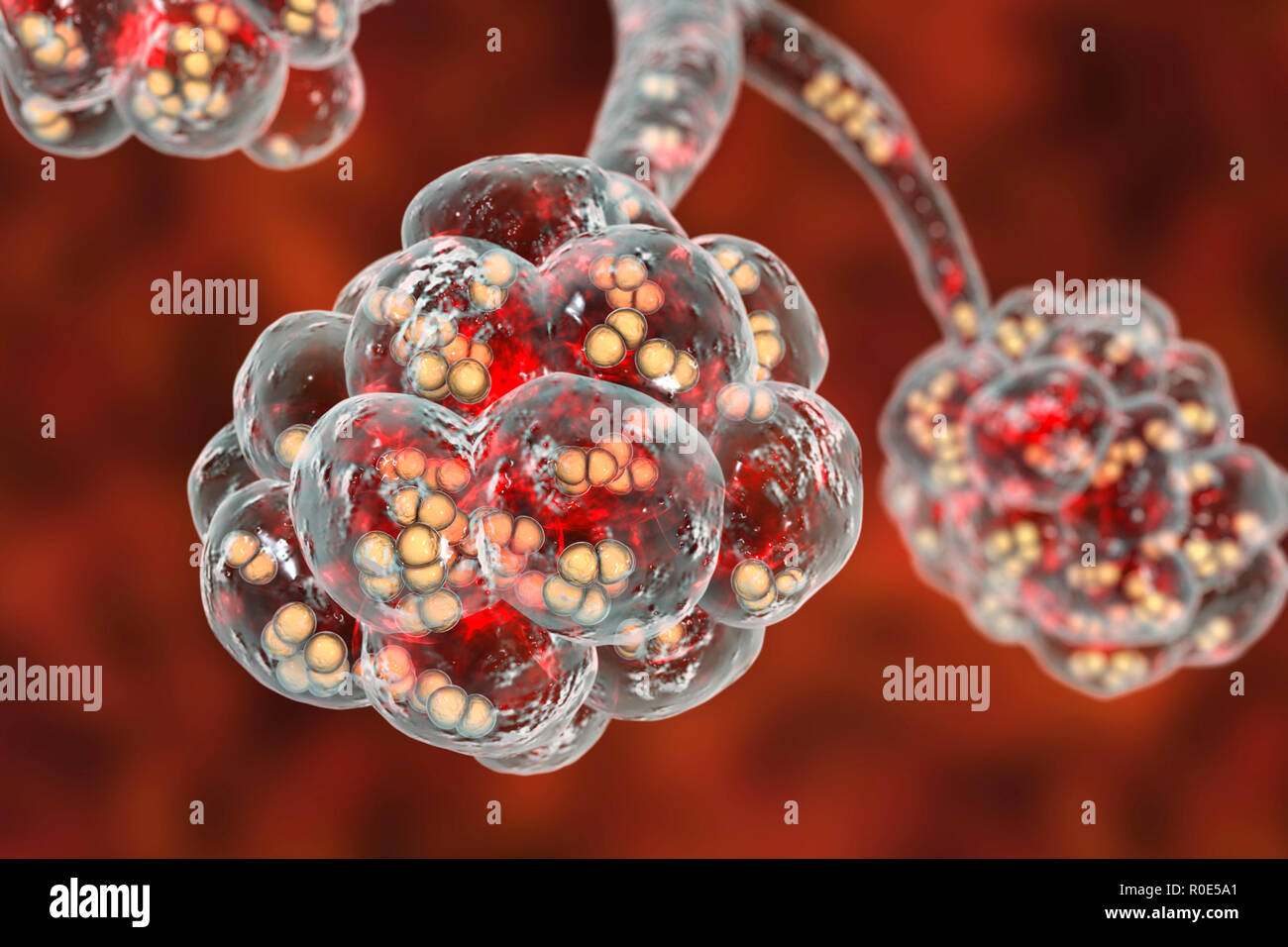 Polmonite pneumococcica. Illustrazione del calcolatore di Streptococcus pneumoniae (pneumococchi) batteri negli alveoli dei polmoni, causando la polmonite. Foto Stock