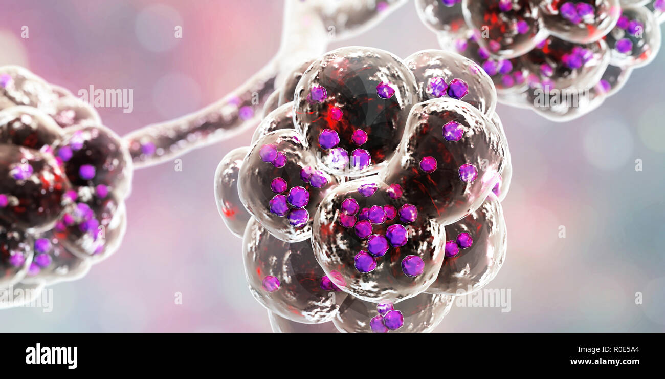 Polmonite da stafilococco. Illustrazione del calcolatore di Staphylococcus aureus batteri negli alveoli dei polmoni, causando la polmonite. Foto Stock