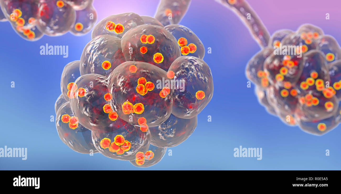 Polmonite da stafilococco. Illustrazione del calcolatore di Staphylococcus aureus  batteri negli alveoli dei polmoni, causando la polmonite Foto stock - Alamy