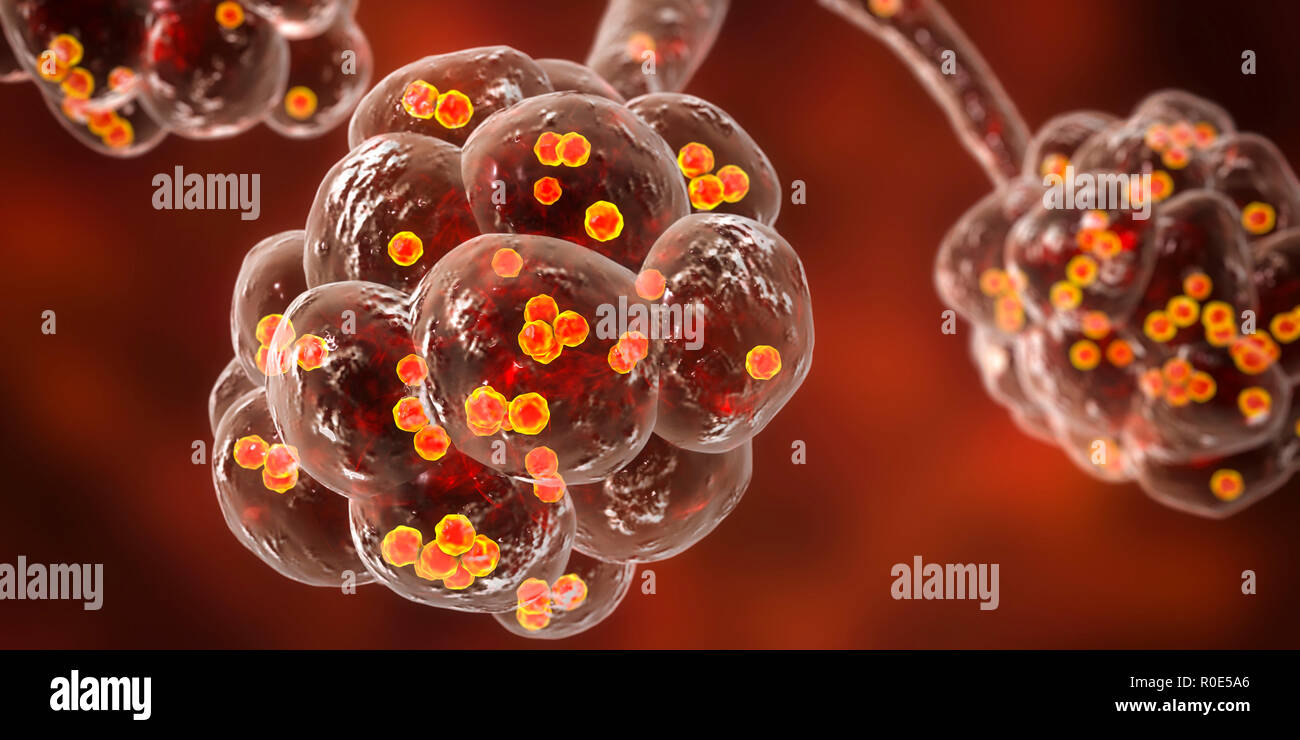 Polmonite da stafilococco. Illustrazione del calcolatore di Staphylococcus  aureus batteri negli alveoli dei polmoni, causando la polmonite Foto stock  - Alamy