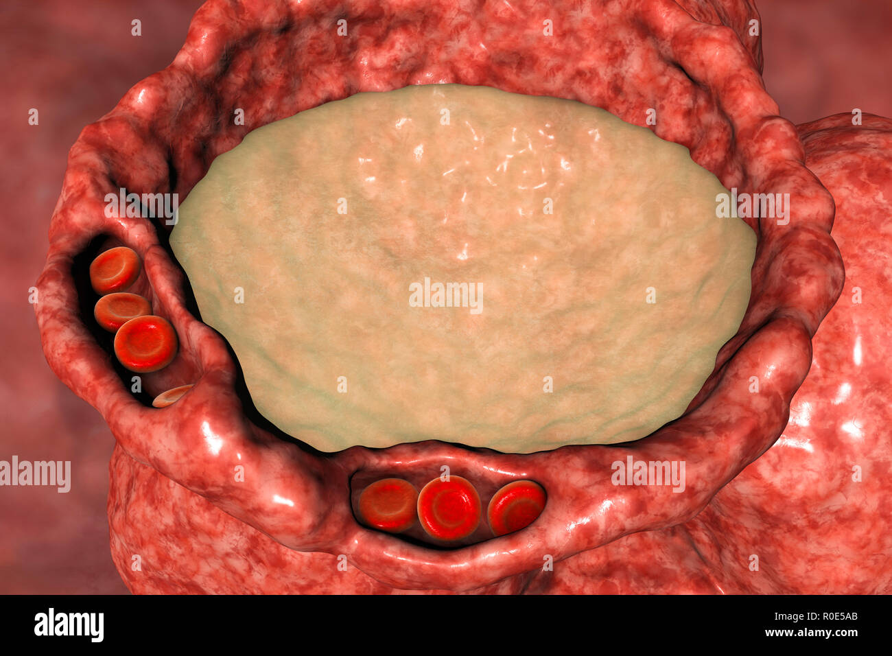 Edema Polmonare Illustrazione Del Computer I Capillari Sono Ormai 