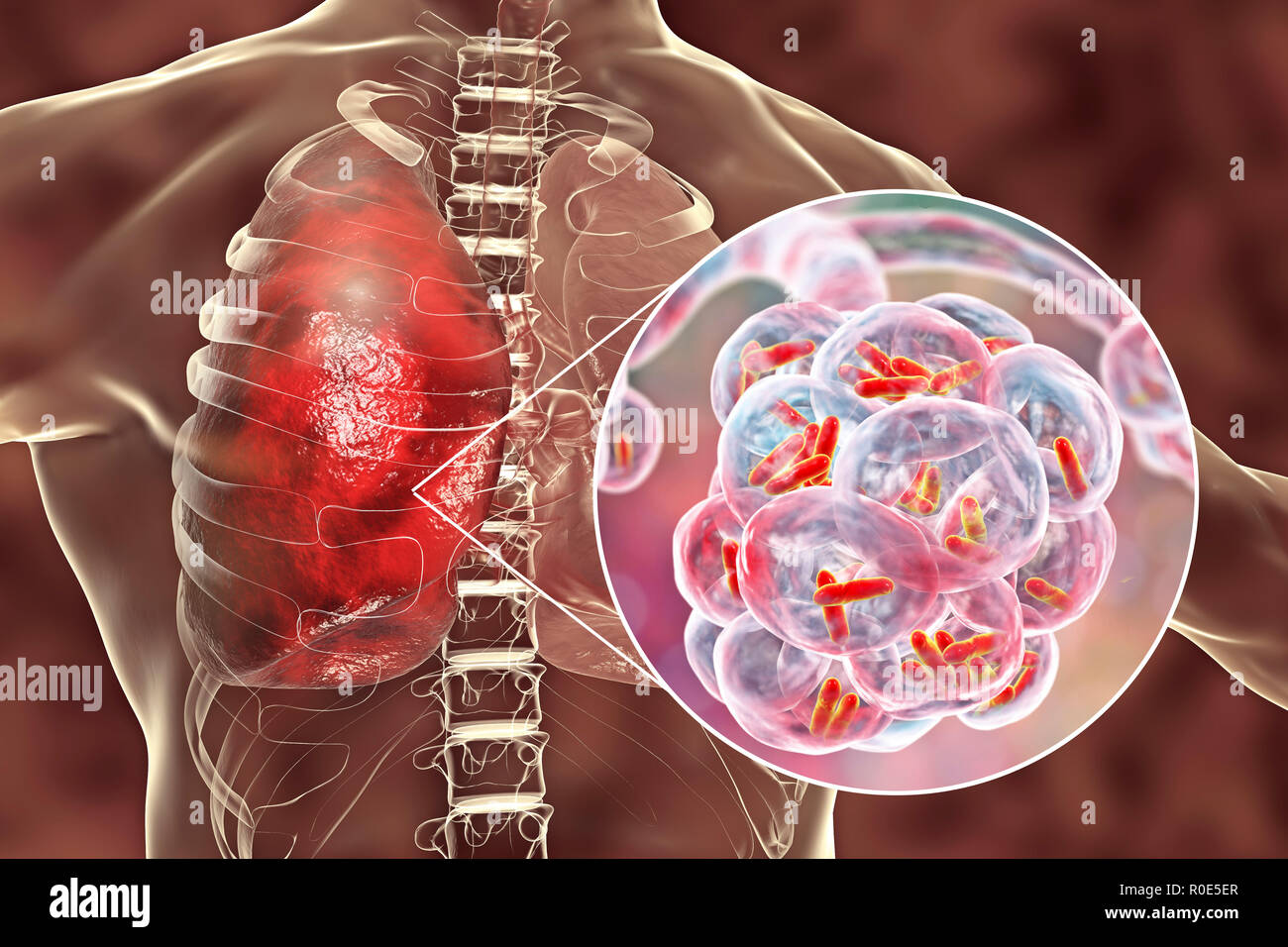 Una polmonite batterica. Computer illustrazione di a forma di asta (batteri bacilli) negli alveoli dei polmoni, causando una infezione dell'apparato respiratorio inferiore. Questo è più generalmente noto come polmonite, sebbene tale termine può anche essere riservati per specifici tipi di infezione. Gravi infezioni polmonari sono diagnosticati da raggi X e trattati con antibiotici. Gli alveoli sono il sito di scambio gassoso tra l'aria nei polmoni e nel sangue. Foto Stock