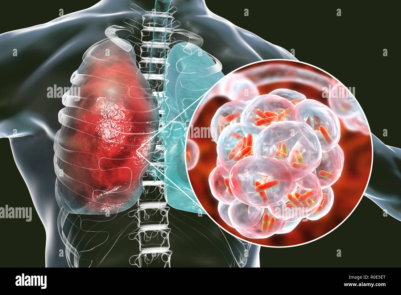 Una polmonite batterica. Computer illustrazione di a forma di asta (batteri bacilli) negli alveoli dei polmoni, causando una infezione dell'apparato respiratorio inferiore. Questo è più generalmente noto come polmonite, sebbene tale termine può anche essere riservati per specifici tipi di infezione. Gravi infezioni polmonari sono diagnosticati da raggi X e trattati con antibiotici. Gli alveoli sono il sito di scambio gassoso tra l'aria nei polmoni e nel sangue. Foto Stock