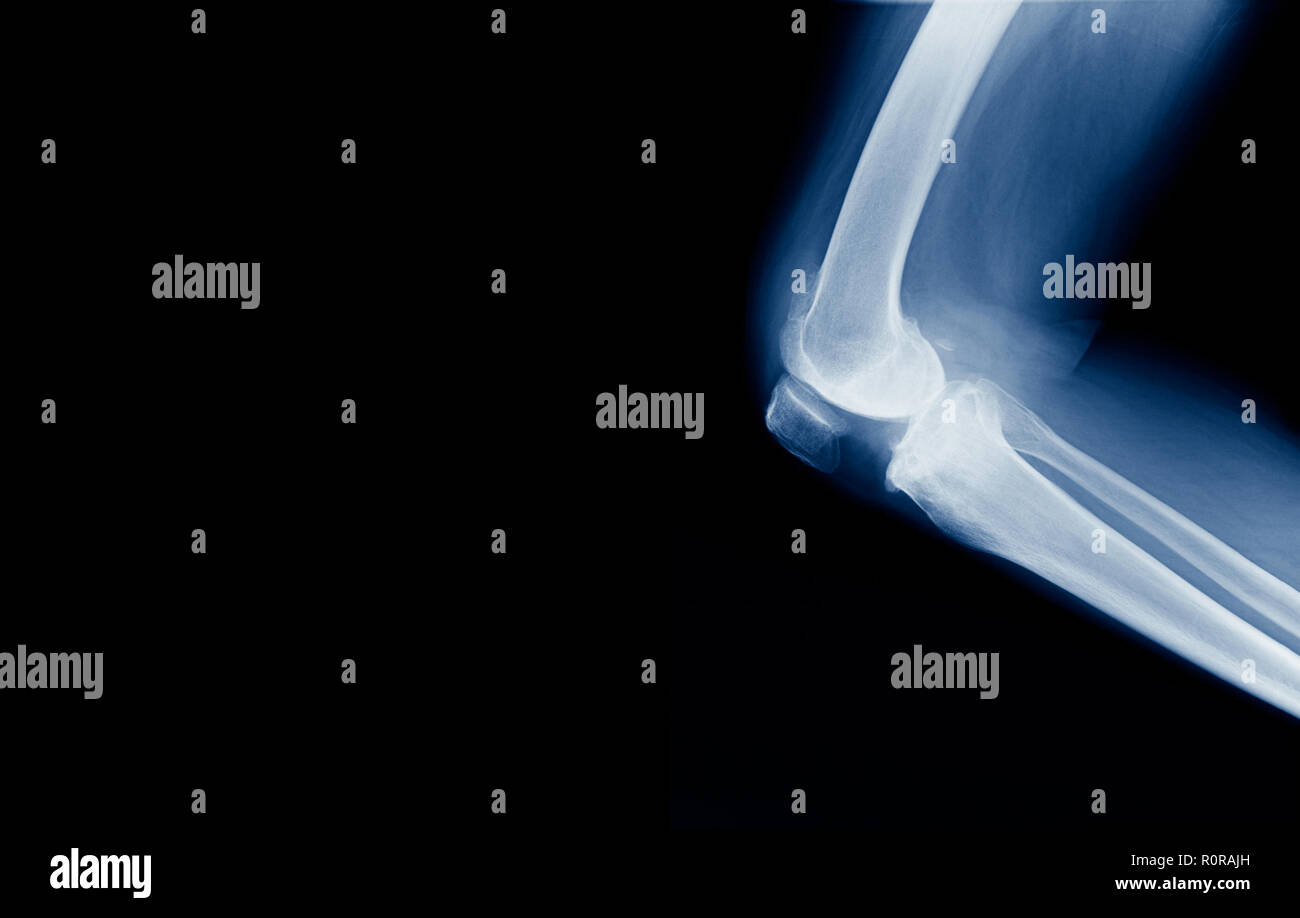 X-ray ginocchio banner per il sito web, alta qualità del ginocchio in posizione di flessione Foto Stock
