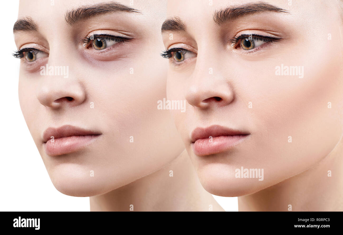 Femmina con occhi lividi sotto gli occhi prima e dopo il trattamento cosmetico. Foto Stock