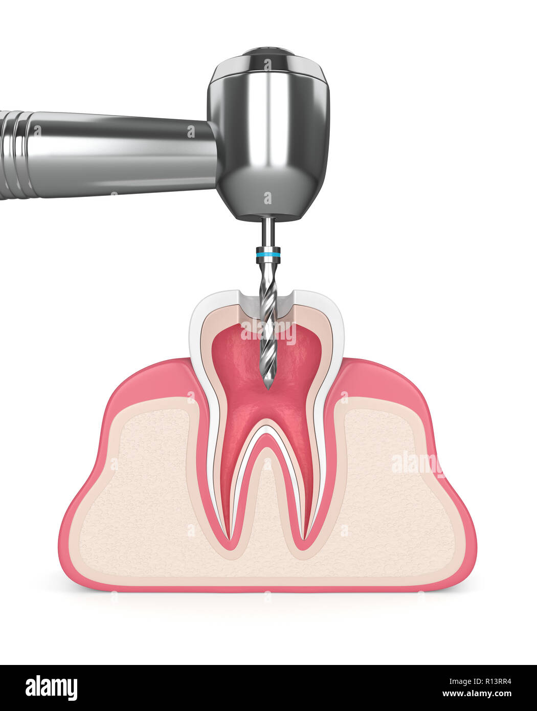 3D render del dente in gomme con trapano dentistico Foto Stock
