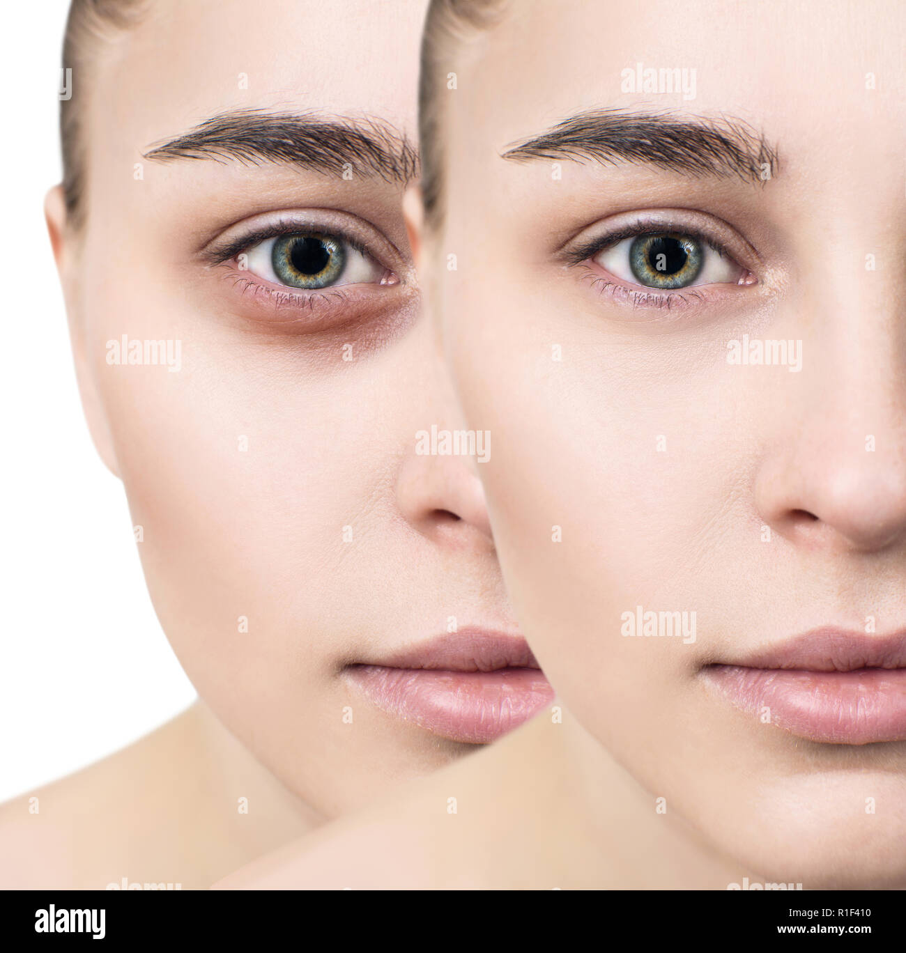Femmina con occhi lividi sotto gli occhi prima e dopo il trattamento cosmetico. Foto Stock