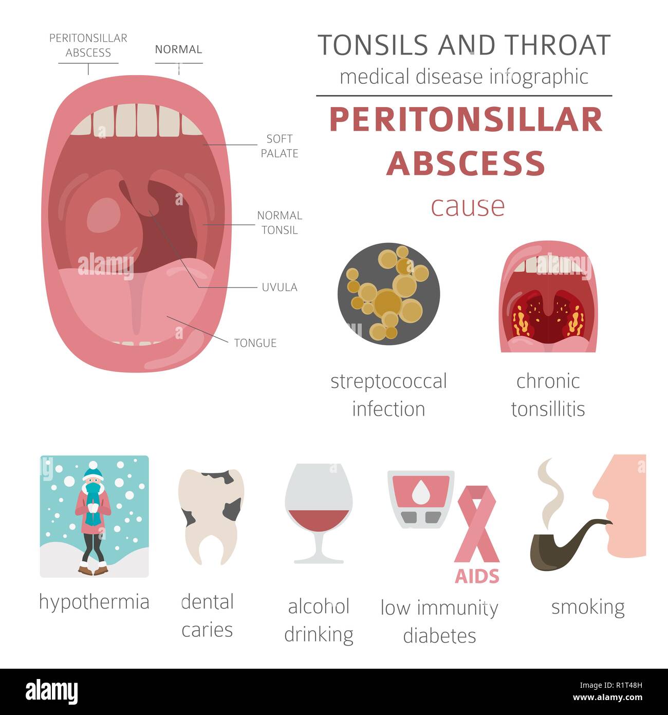 Le tonsille e malattie della gola. Peritonsillar ascesso sintomi, trattamento icon set. Infografico medica design. Illustrazione Vettoriale Illustrazione Vettoriale