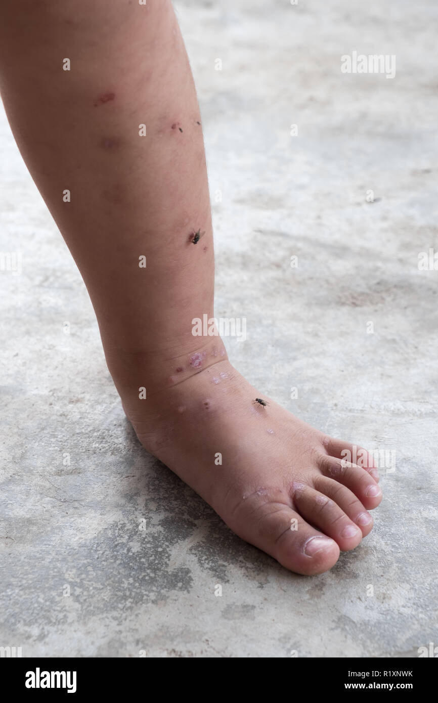 Prurito Dermatite atopica baby calcio. Close up ferita infetta.ferita aperta sulla gamba sinistra. Foto Stock