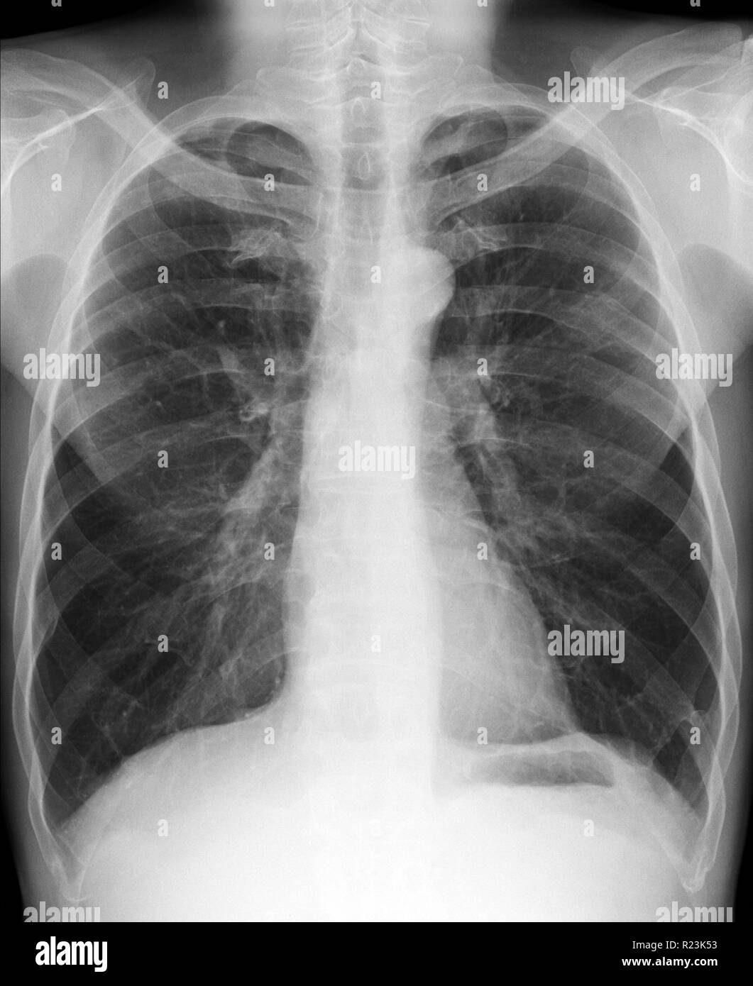 X-ray immagine medica - torace e polmoni Foto Stock