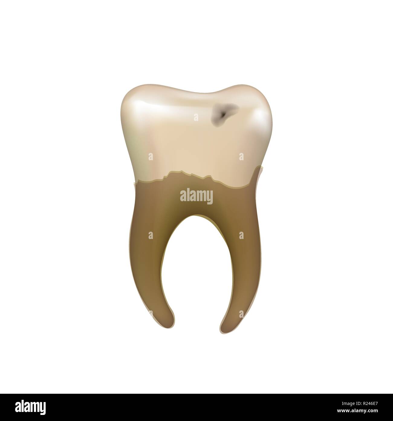 Vecchi malati dente umano con la carie isolato su bianco Illustrazione Vettoriale