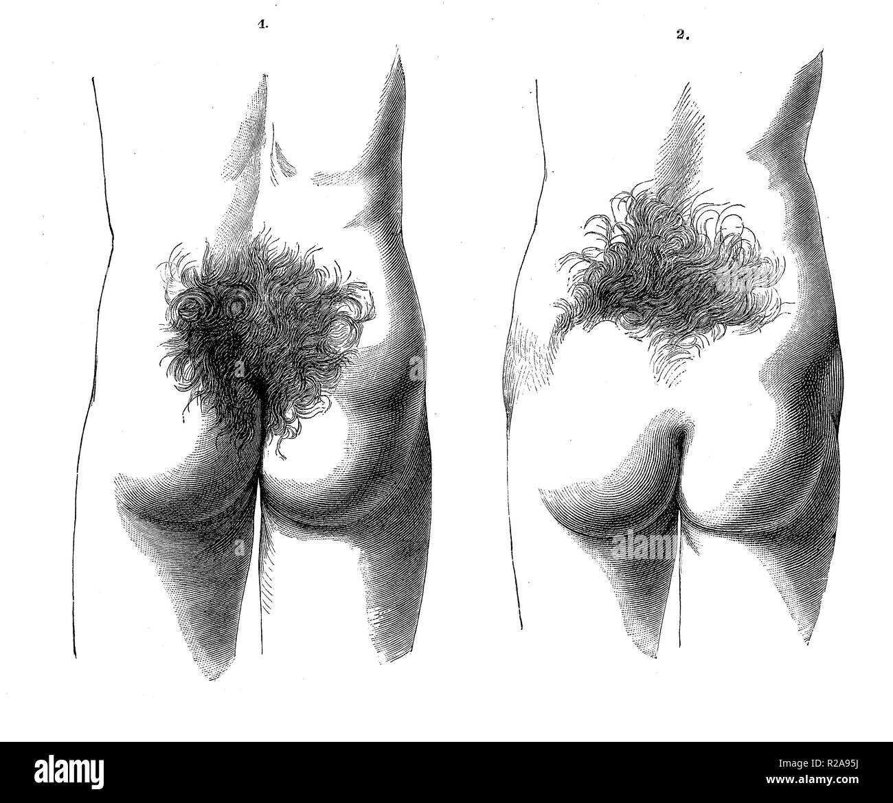 Vintage illustrazione di anatomia umana, maschio e femmina, trichosis pelosità nella regione sacrale Foto Stock