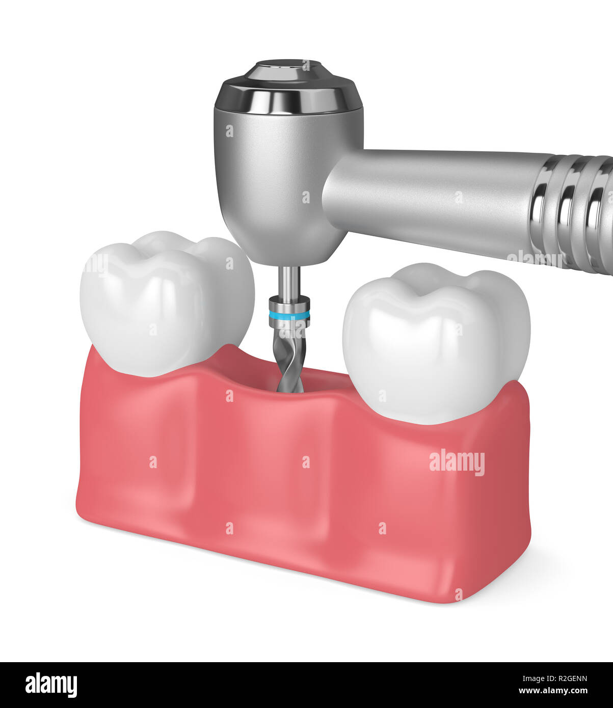3D render di denti con trapano dentistico. Impianto dentale concept Foto Stock