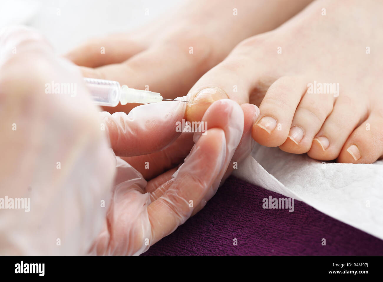 Iniezione di analgesico rimozione chirurgica del chiodo incarniti. iniezione sulle dita del piede. il medico inietta un farmaco analgesico nella donna di punta. Foto Stock