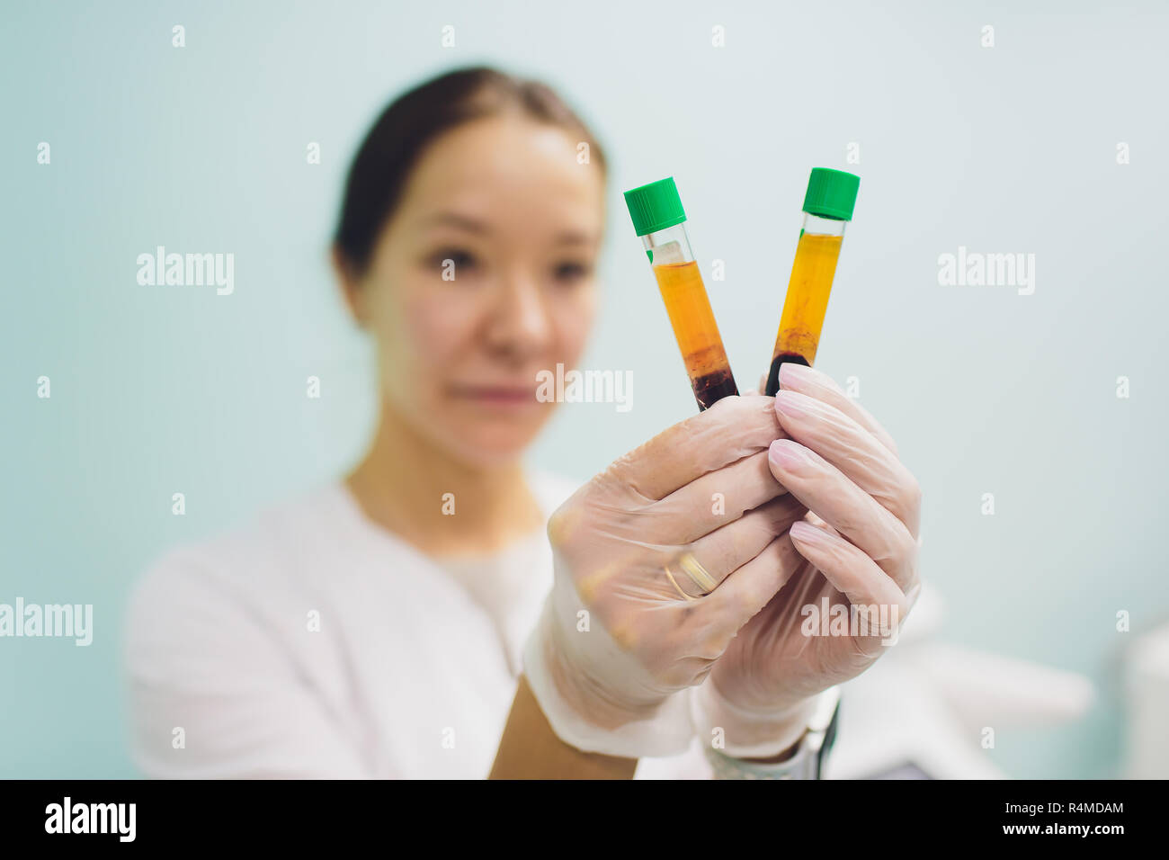 Preparazione per Plasmolifting. Provette per prelievo ematico in due strati divisi per centrifugazione dopo la manipolazione di personalizzazione. Foto Stock