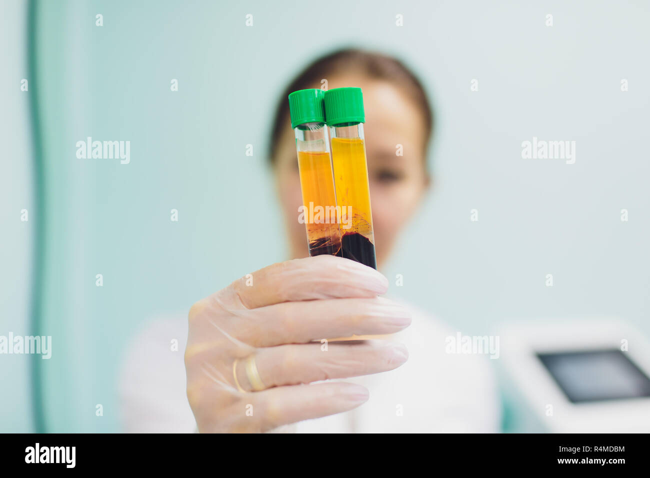 Preparazione per Plasmolifting. Provette per prelievo ematico in due strati divisi per centrifugazione dopo la manipolazione di personalizzazione. Foto Stock