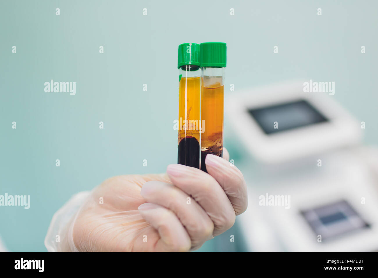 Preparazione per Plasmolifting. Provette per prelievo ematico in due strati divisi per centrifugazione dopo la manipolazione di personalizzazione. Foto Stock