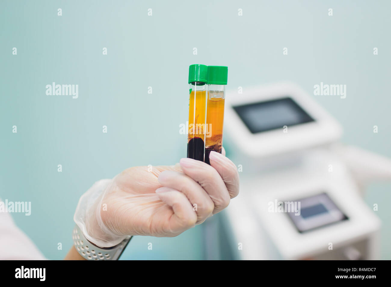 Preparazione per Plasmolifting. Provette per prelievo ematico in due strati divisi per centrifugazione dopo la manipolazione di personalizzazione. Foto Stock