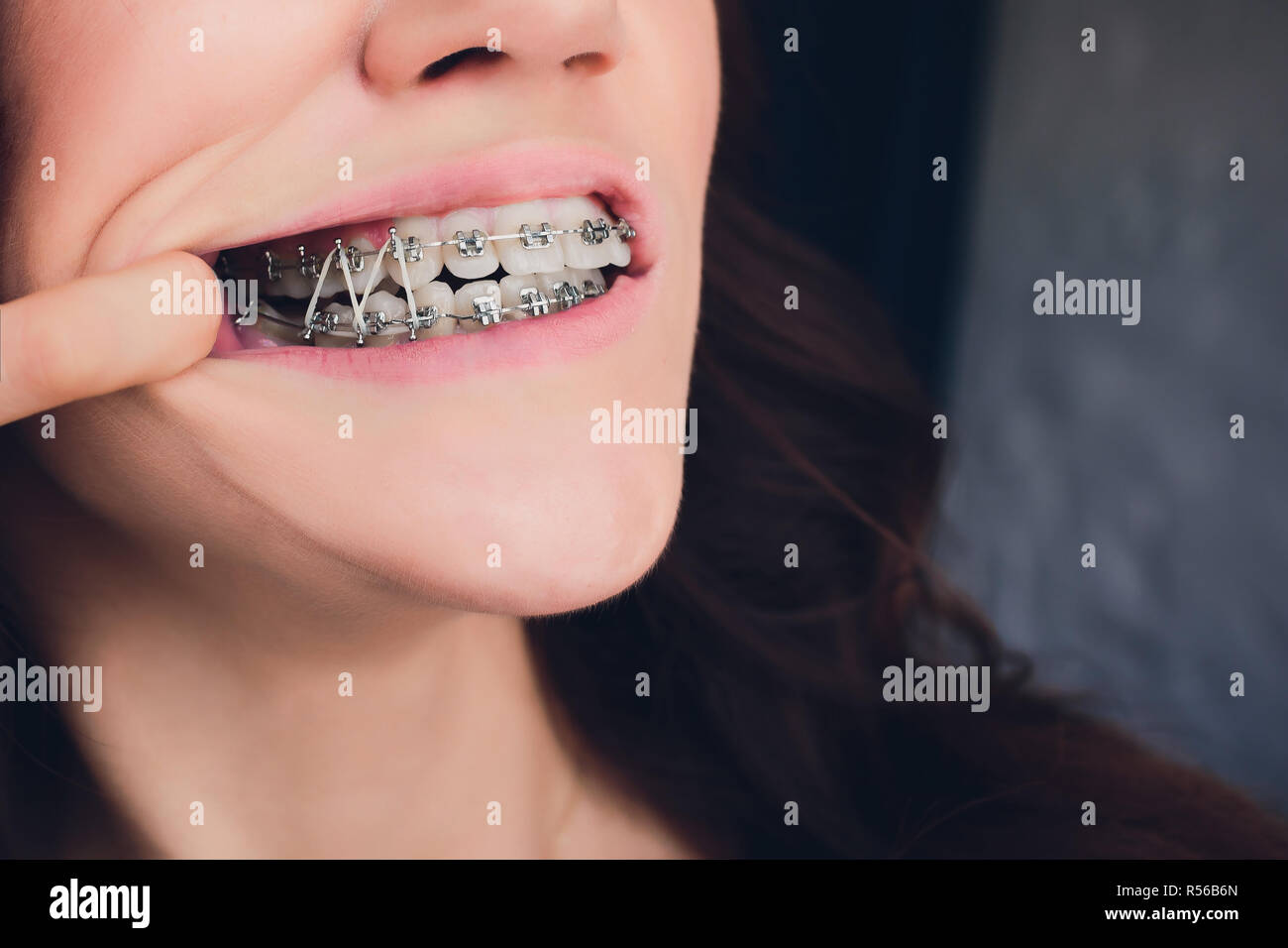 Orthodontic elastic bands immagini e fotografie stock ad alta risoluzione -  Alamy