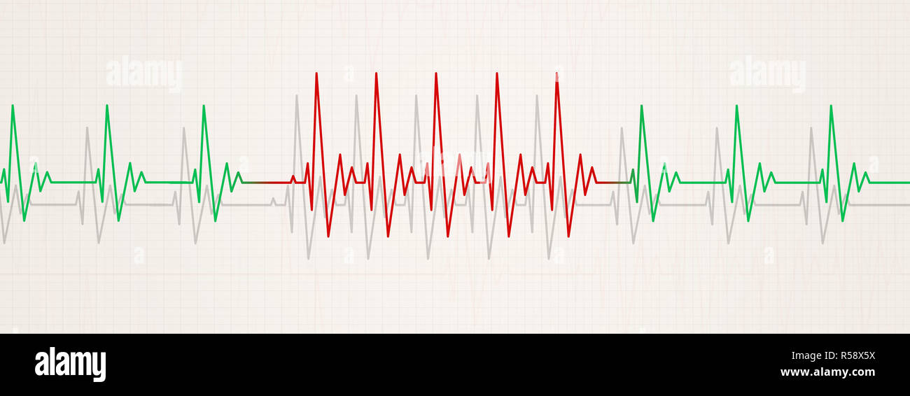Banner di medicina che illustra improvvisa aritmia. La frequenza cardiaca aumenta di più di 90 battiti al minuto Foto Stock