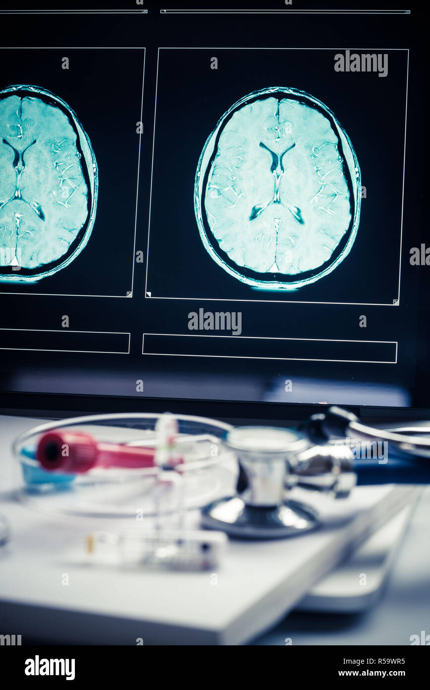 Computer che mostra una risonanza magnetica (RM) scansione di una testa umana contenenti un cervello integro. Foto Stock