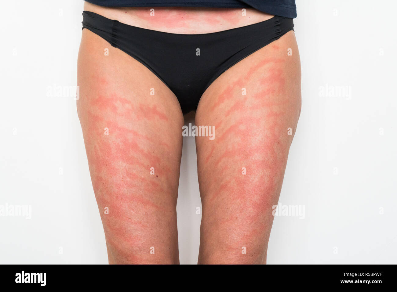Dermatite allergica da contatto immagini e fotografie stock ad alta  risoluzione - Alamy