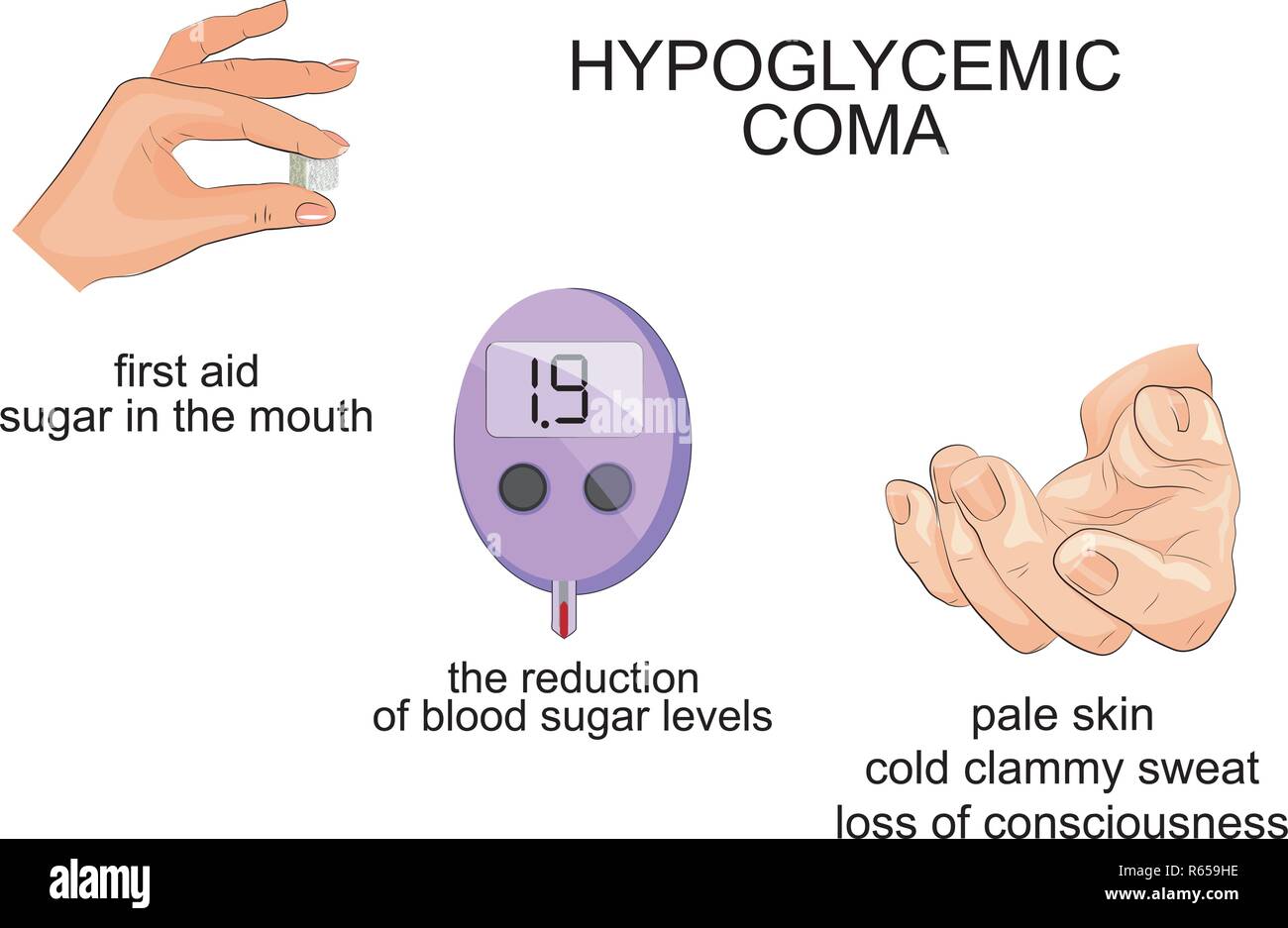 Illustrazione dei sintomi e coma ipoglicemico. infographics Illustrazione Vettoriale