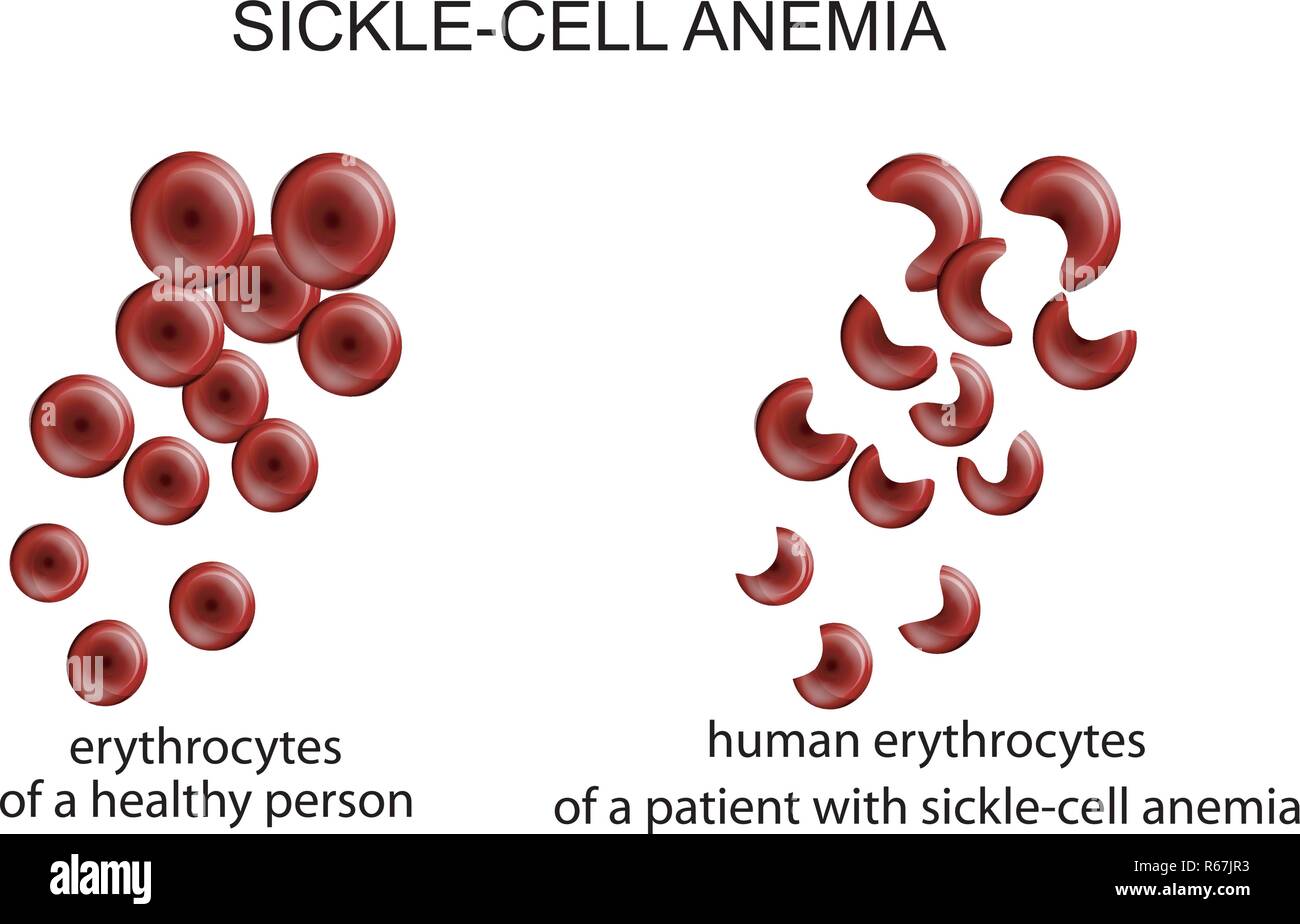 Illustrazione di cellule del sangue in malattia anemia falciforme Illustrazione Vettoriale