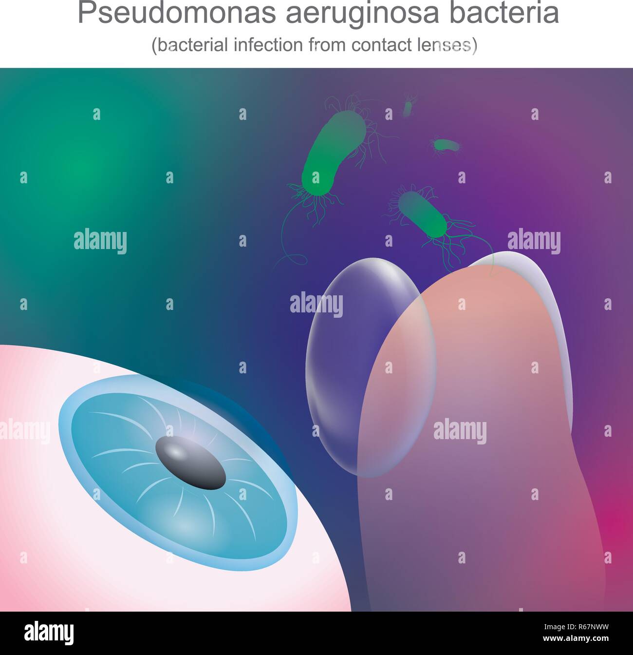 Le infezioni batteriche da lenti a contatto, è resistente agli antibiotici. Illustrazione Vettoriale