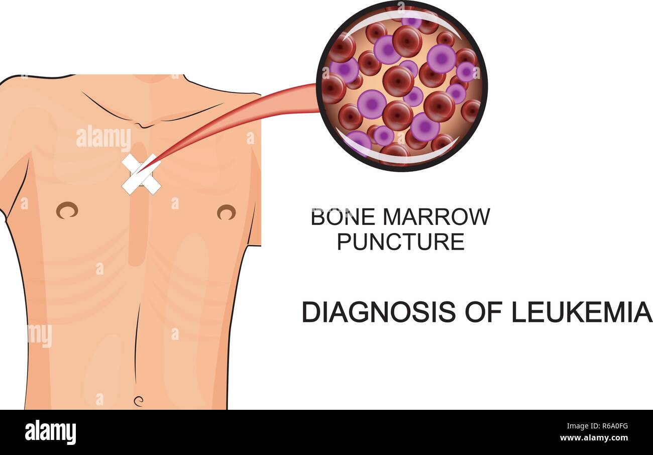 Leucemia. illustrazione di analisi del midollo osseo biopsia Illustrazione Vettoriale