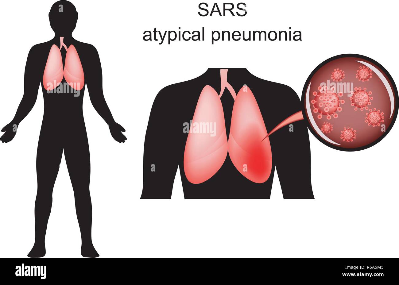 Illustrazione della SARS. infiammazione dei polmoni e l'agente causativo. virus Illustrazione Vettoriale
