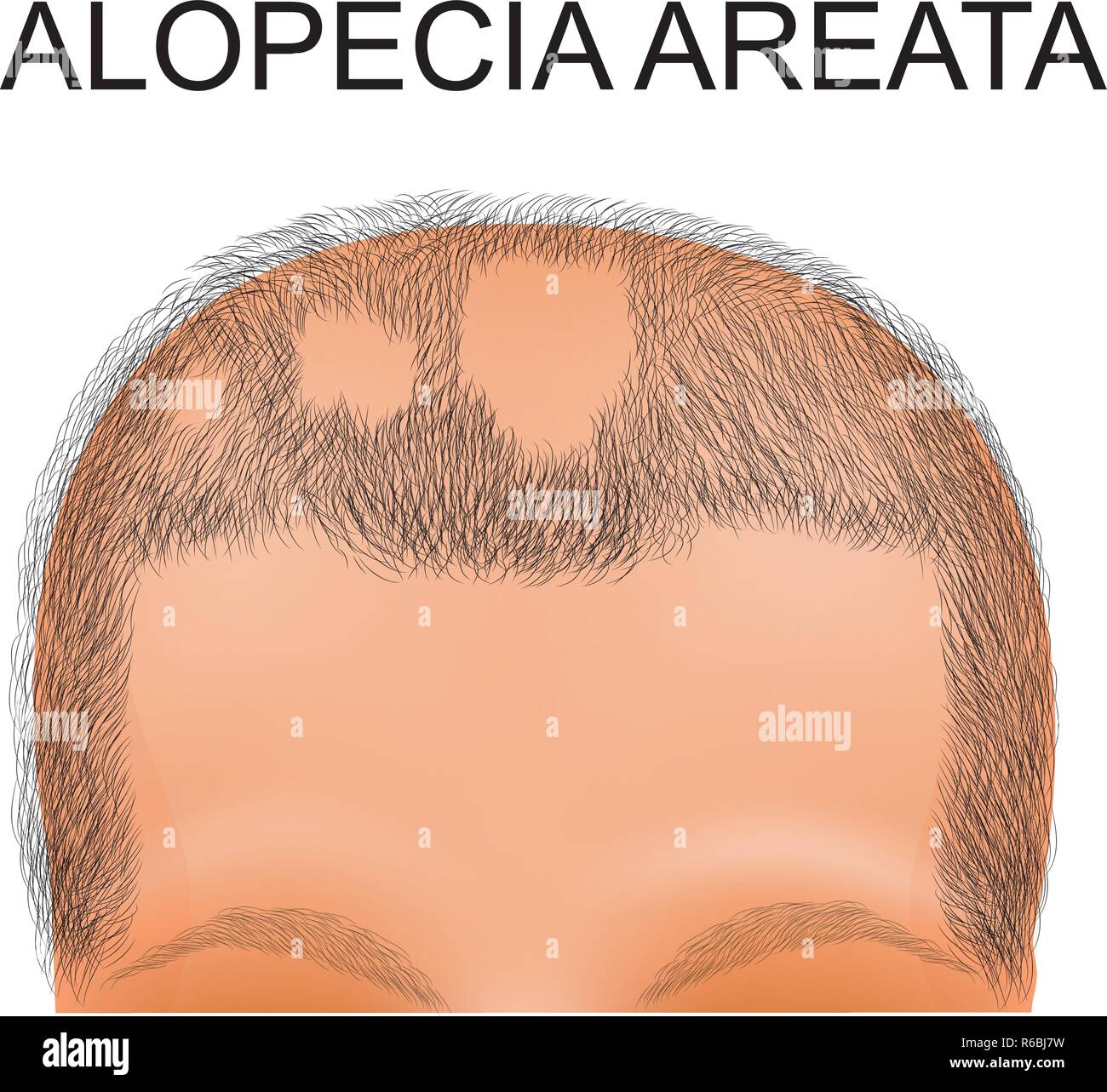 Illustrazione di una testa della persona che soffre di alopecia areata Illustrazione Vettoriale