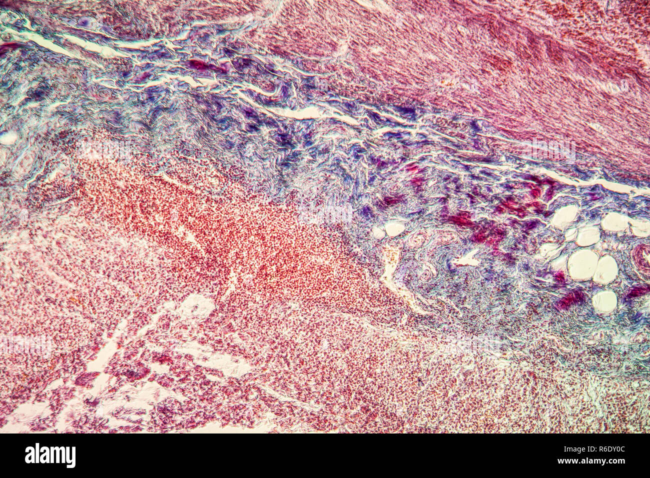 Appendicite tessuto malato 100x Foto Stock